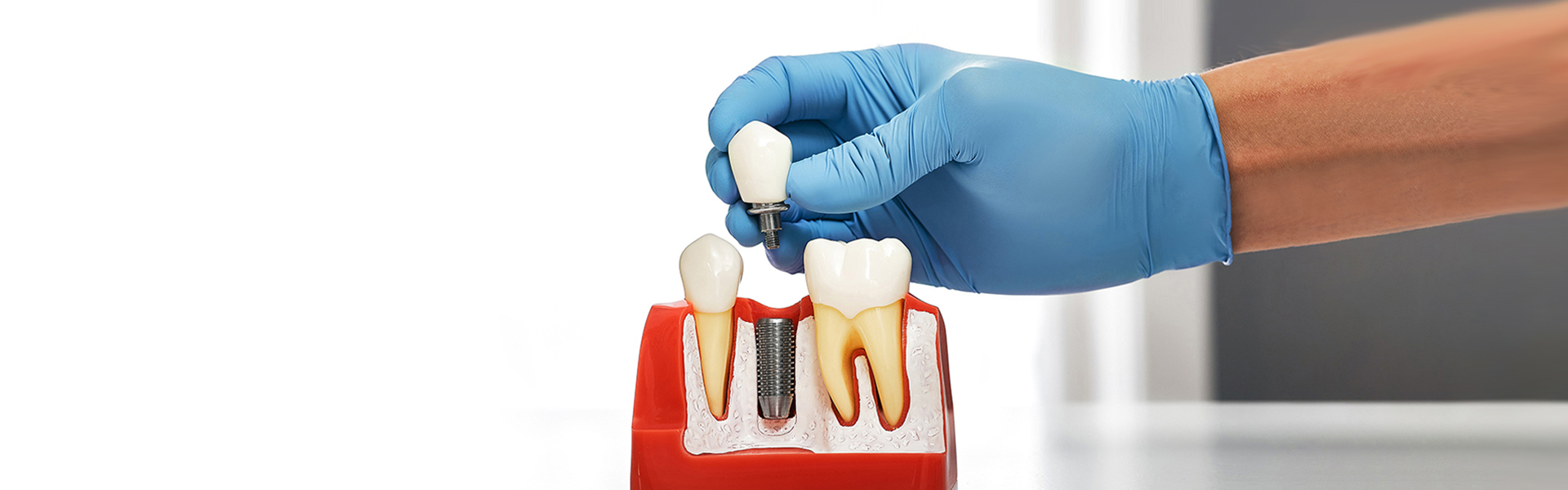 What Are Dental Implants and How Do They Work?