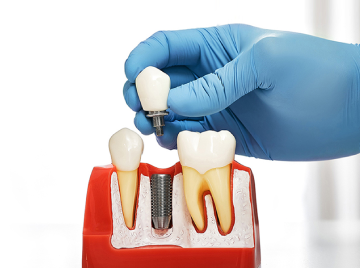 What Are Dental Implants and How Do They Work?